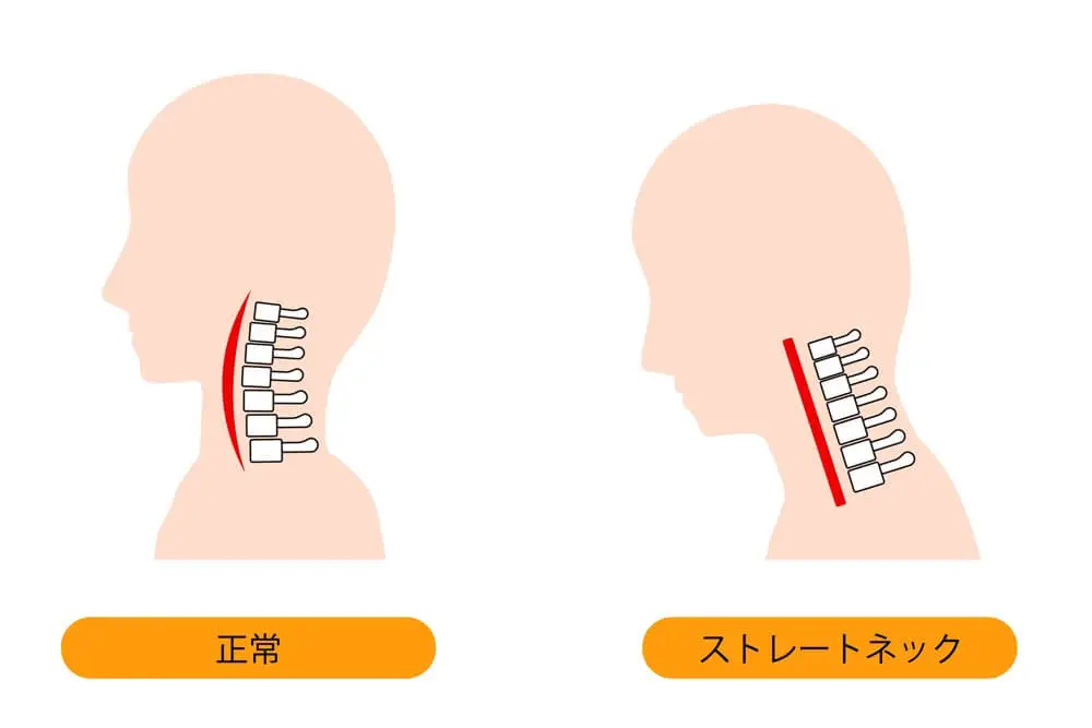 スマホ首になると、頸椎がストレートネックになる。